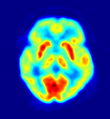 PET scan