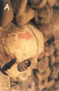 Skull with frontal suture