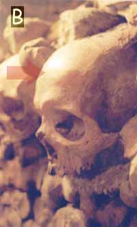 standard frontal bone